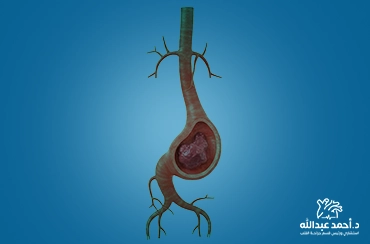 تمدد-الشريان-الأورطي-البطني